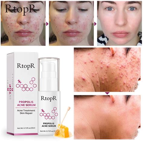 What is Propolis in Skin Care: A Sticky Solution to Glowing Skin